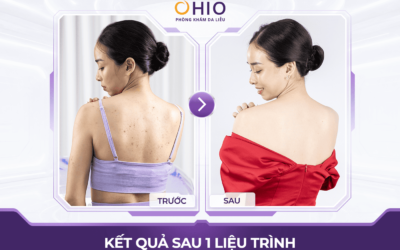 Điều trị viêm nang lông