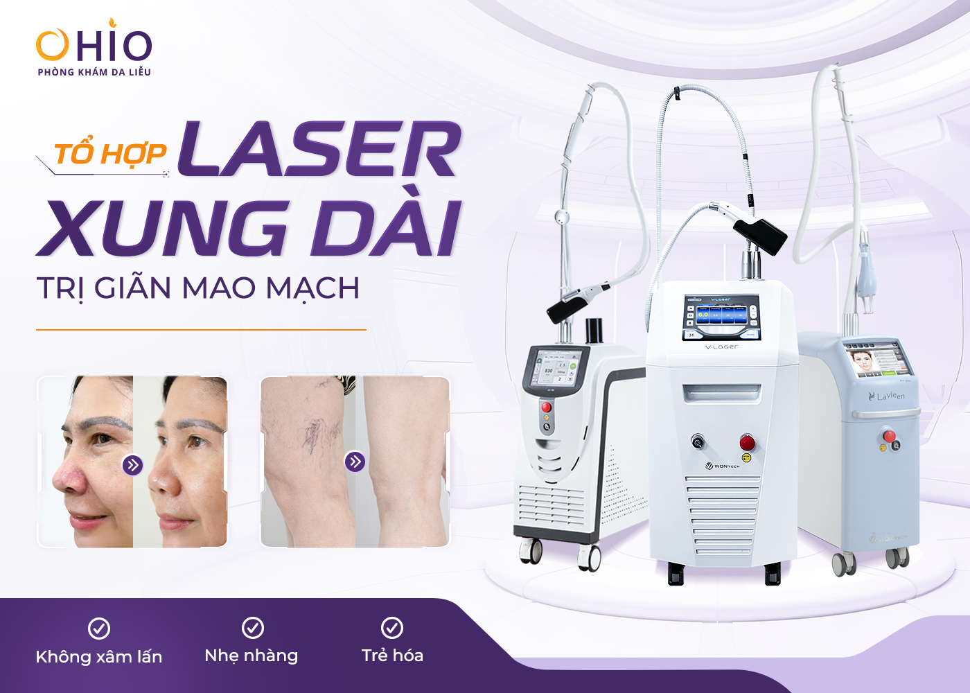 Giãn mao mạch điều trị dứt điểm với tổ hợp Công nghệ laser xung dài