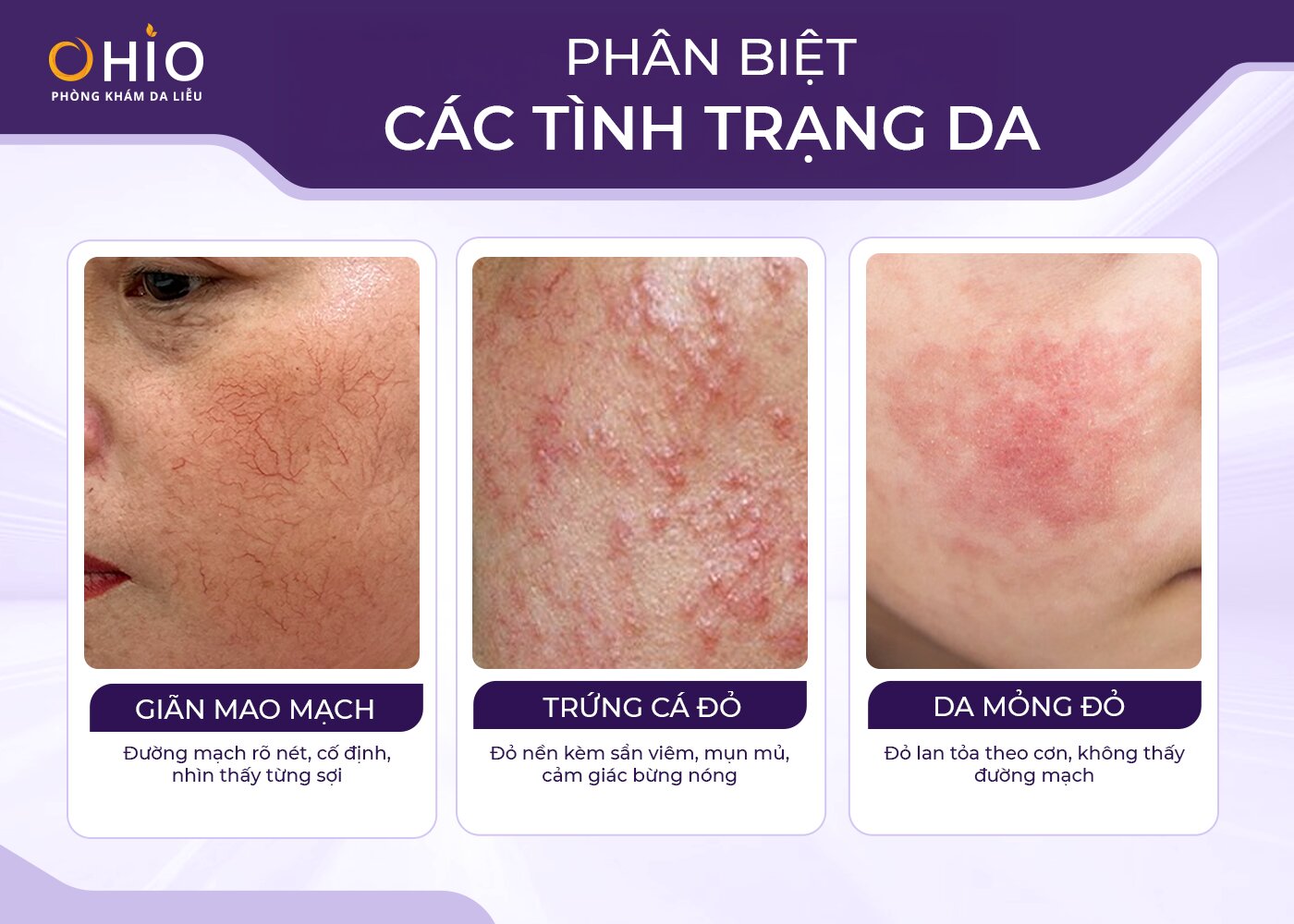 Điều trị giãn mao mạch mặt - Phòng khám da liễu OHIO Điều trị giãn mao mạch mặt tại OHIO