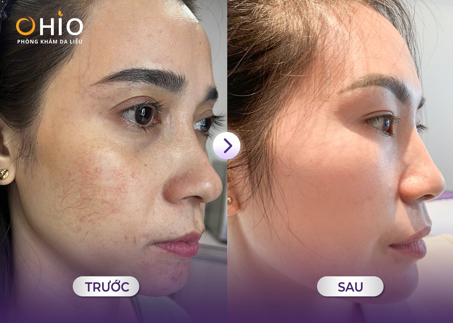 Điều trị giãn mao mạch mặt - Phòng khám da liễu OHIO Điều trị giãn mao mạch mặt tại OHIO