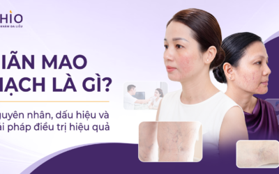 Điều trị giãn mao mạch mặt