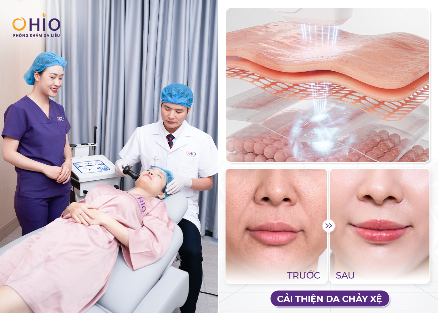 Nâng cơ săn chắc, trẻ hóa da - Phòng khám da liễu OHIO Công nghệ Ultra Deeptech nâng cơ tại OHIO