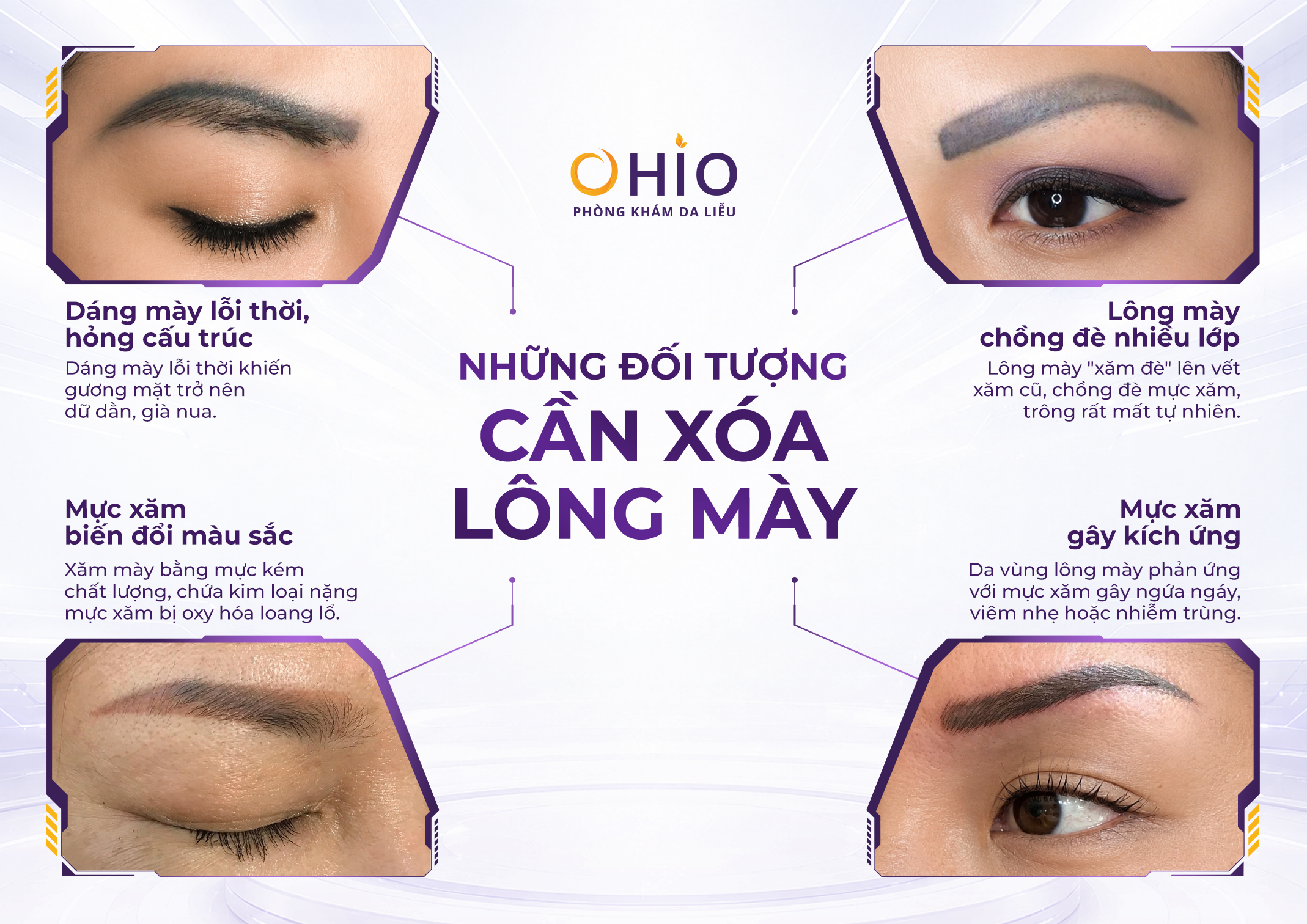 Những trường hợp cần xóa xăm lông mày