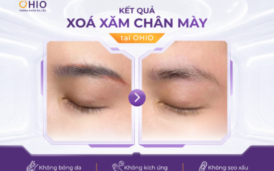 Xóa xăm lông mày, môi và mí mắt