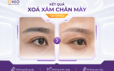 Xóa xăm lông mày, môi và mí mắt