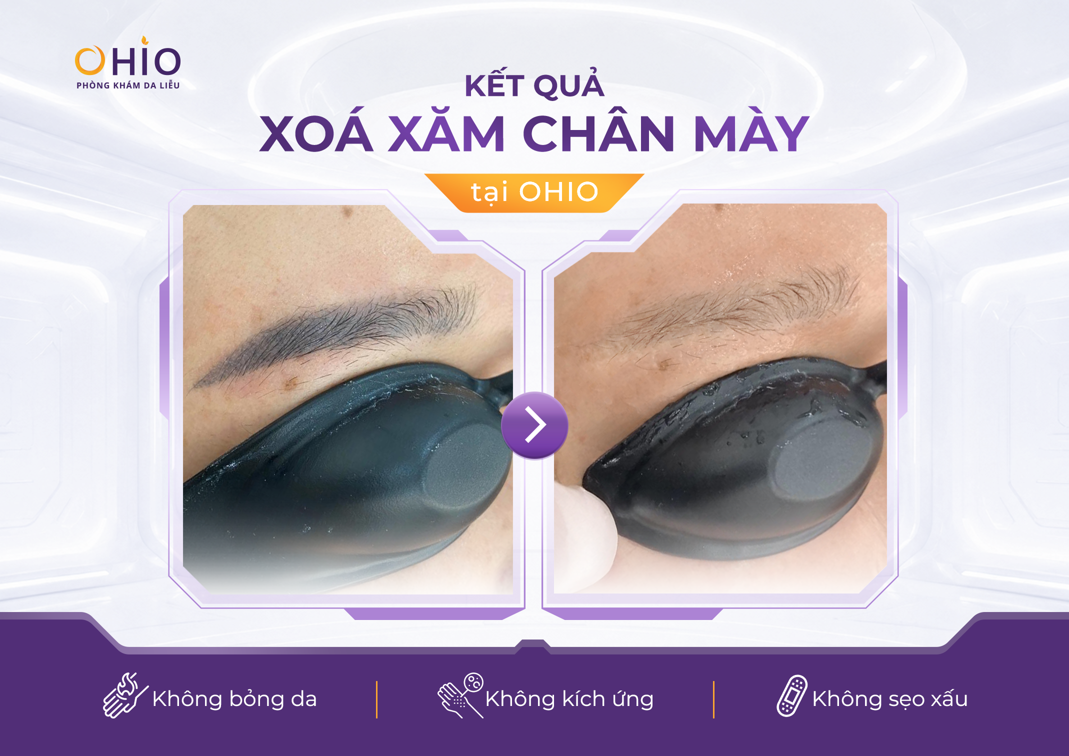 Kết quả xóa xăm chân mày tại OHIO
