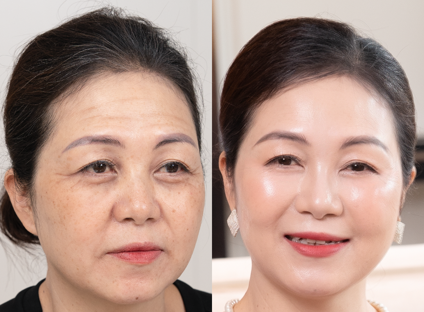 Hình ảnh trước và sau – U60 vẫn trẻ đẹp tự tin, hành trình trẻ hóa da của chị Vũ Hồng Hạnh