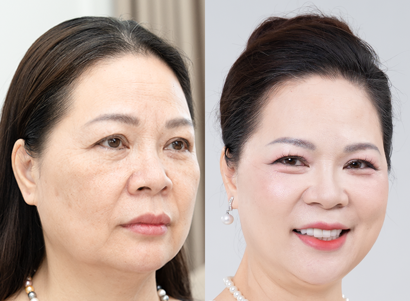 Hình ảnh trước và sau – Trẻ hóa da không xâm lấn: Hành trình tìm lại nhan sắc ở tuổi 57 của hoa khôi
