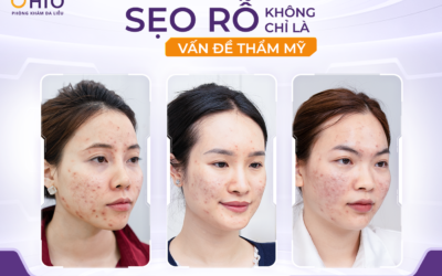 Điều trị sẹo rỗ