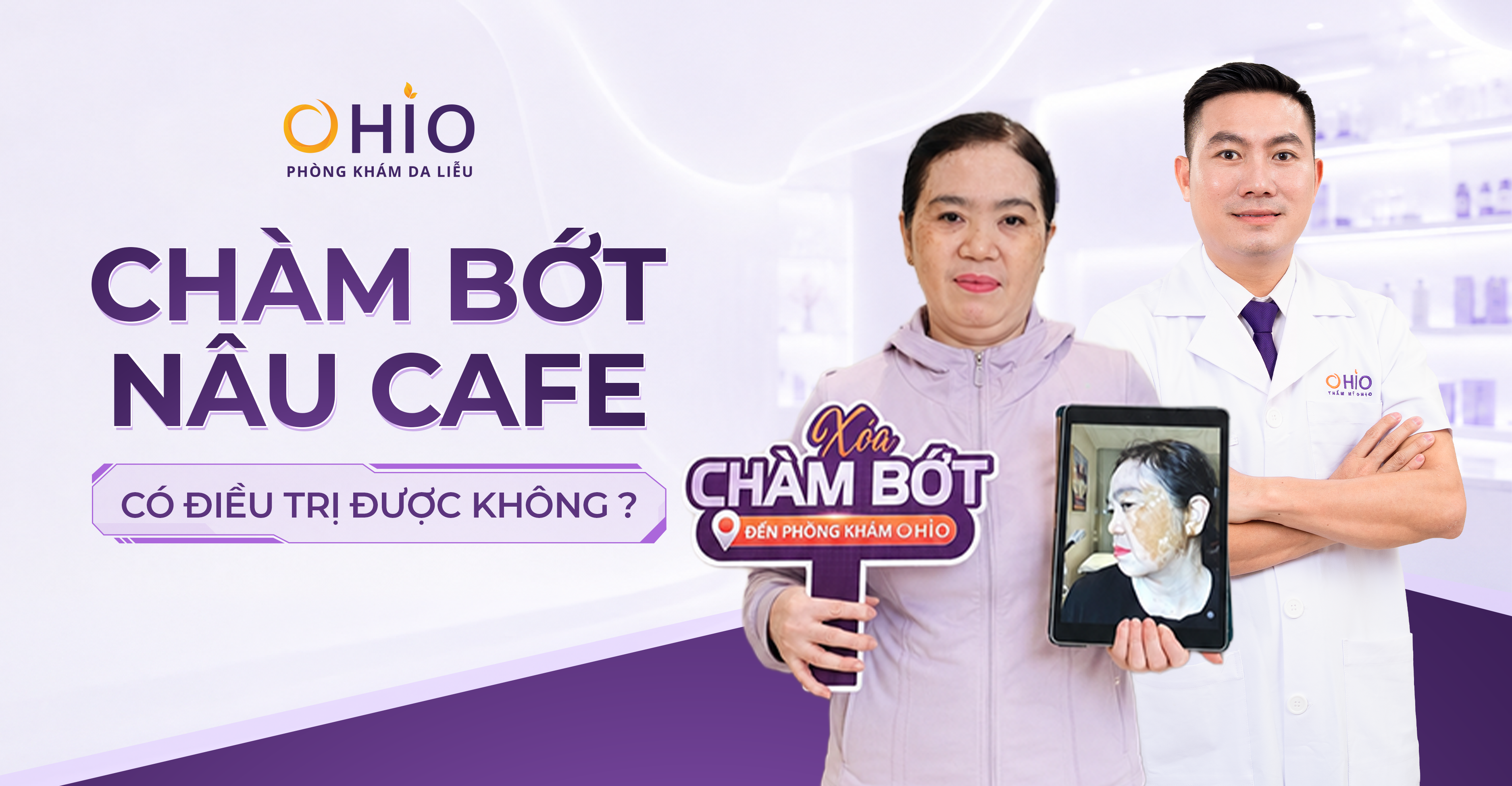 Chàm bớt nâu cafe có điều trị được không? Giải đáp từ Bác sĩ Da liễu