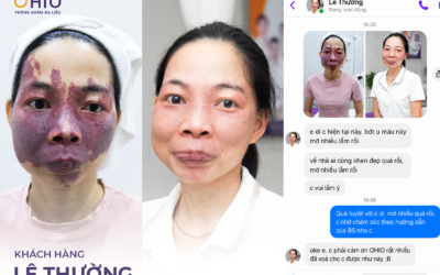 Điều trị u mạch máu
