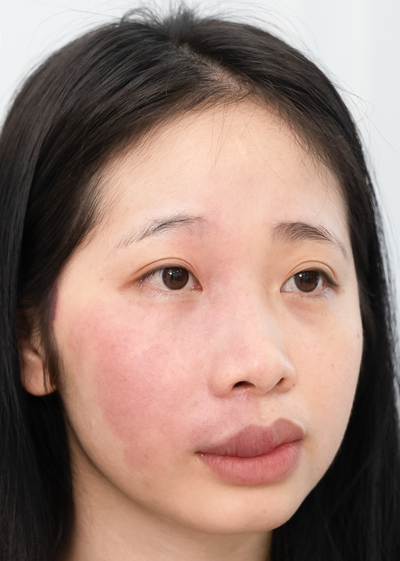 U máu Chị Ngọc Ánh | Nhân viên văn phòng - Sau