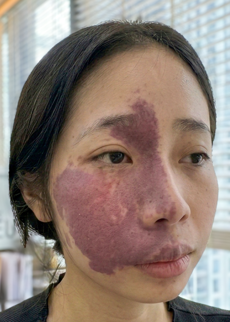 U máu Chị Ngọc Ánh | Nhân viên văn phòng - Trước
