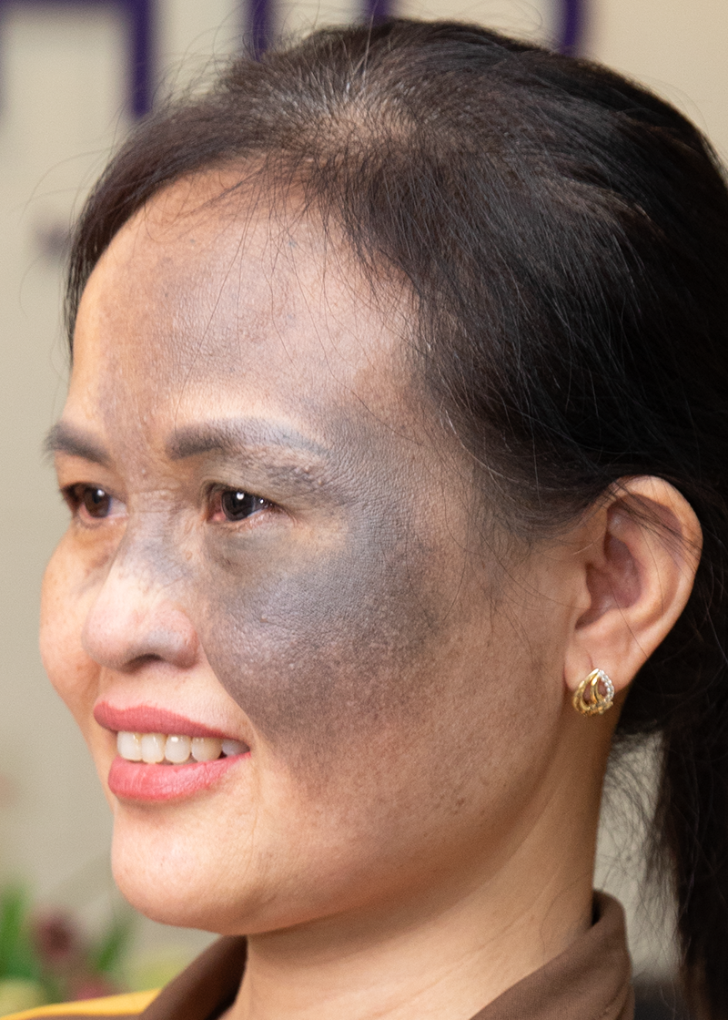 Bớt OTA Chị Huệ | Tự do - Trước