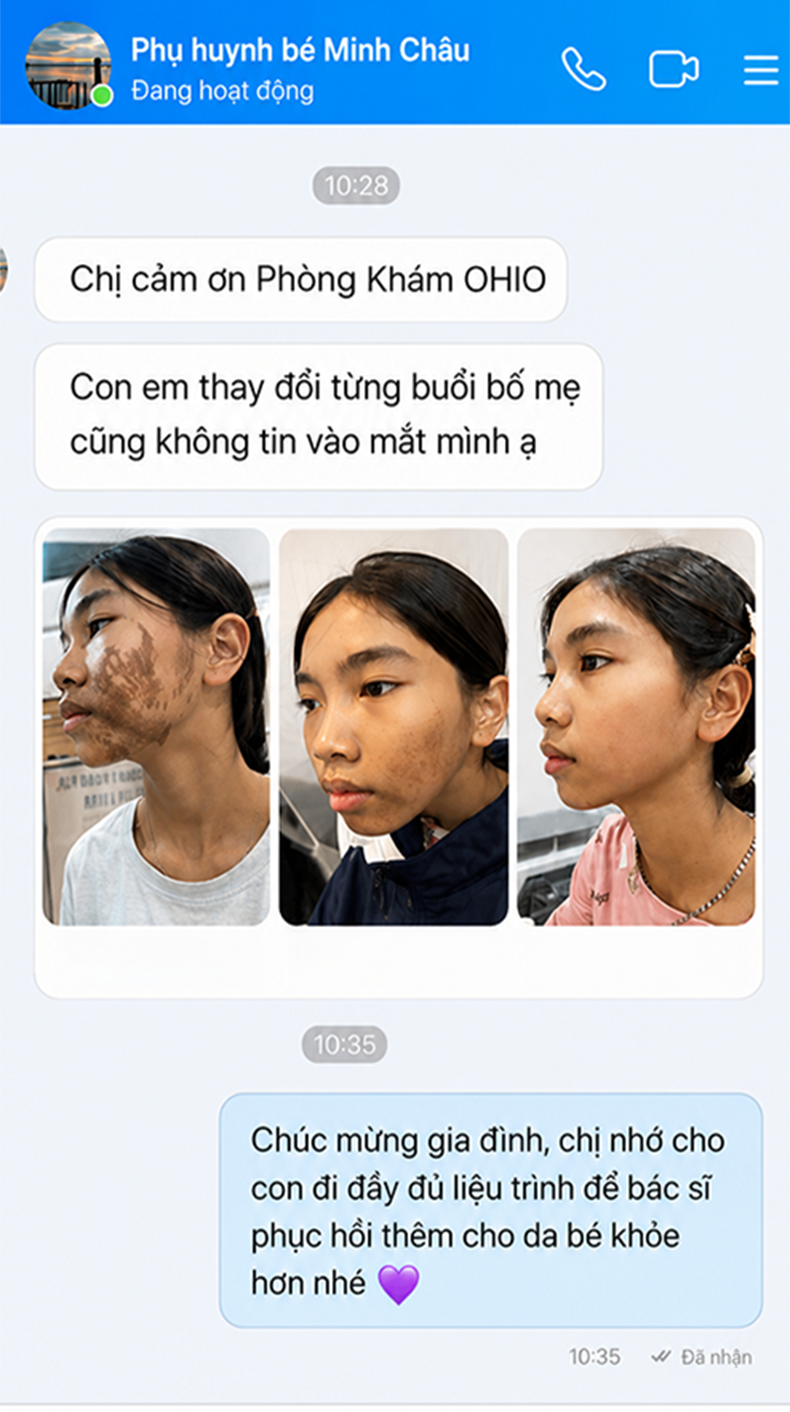Bớt Nâu Bé Minh Châu | Học sinh