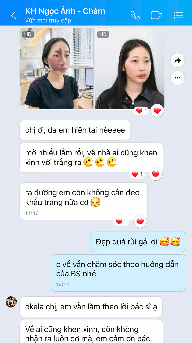 U máu Chị Ngọc Ánh | Nhân viên văn phòng