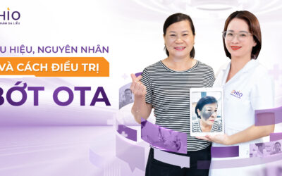 Chàm bớt OTA là gì? Nguyên nhân hình thành và phương pháp điều trị hiện nay