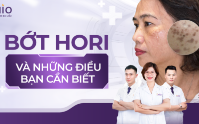Bớt Hori là gì? Có điều trị được không ? giải đáp từ Bác sĩ OHIO