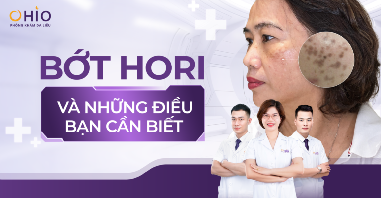 Bớt Hori là gì? Có điều trị được không ? giải đáp từ Bác sĩ OHIO