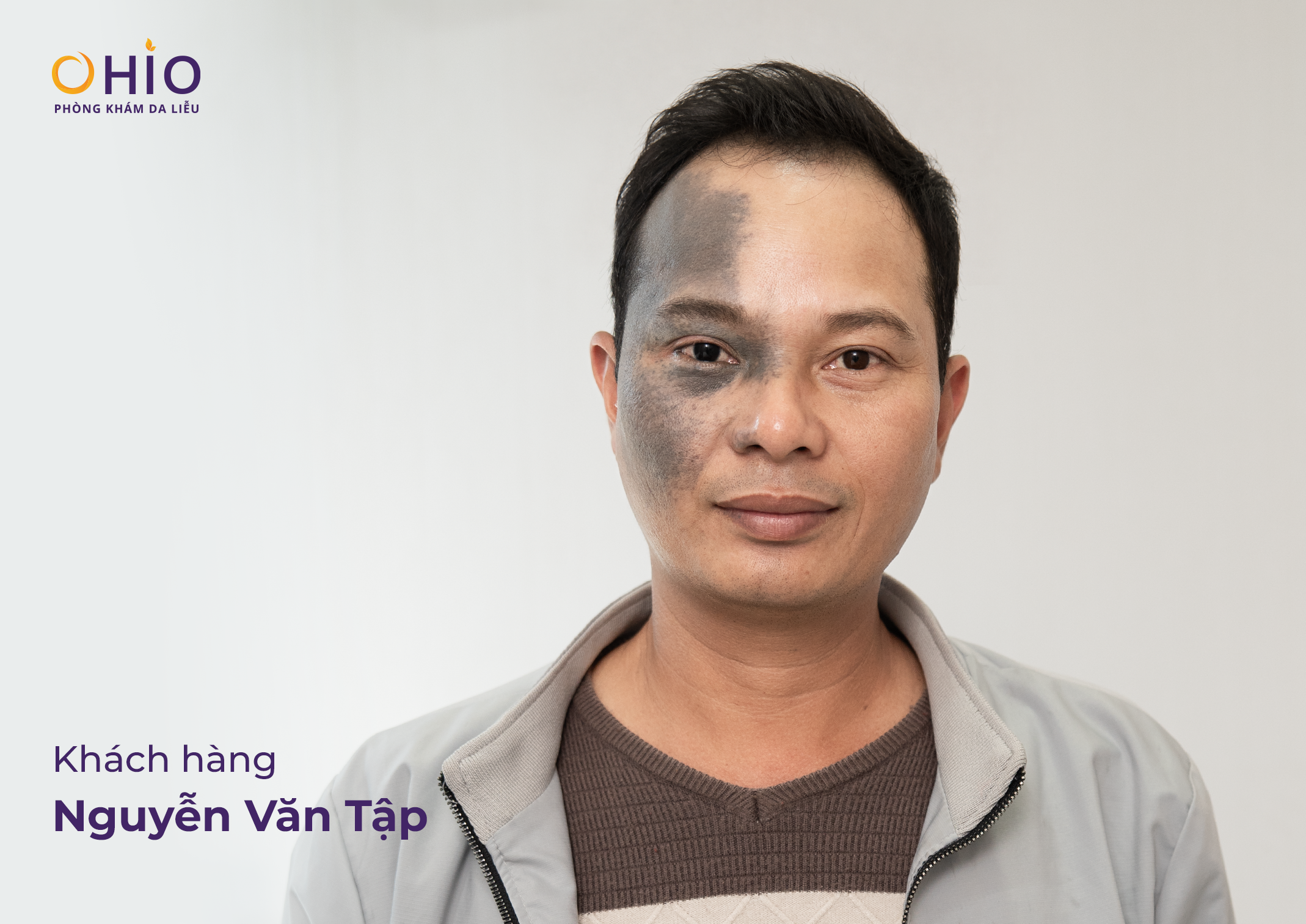 Hành trình xóa chàm bớt đầy “kỳ tích” của anh Nguyễn Văn Tập