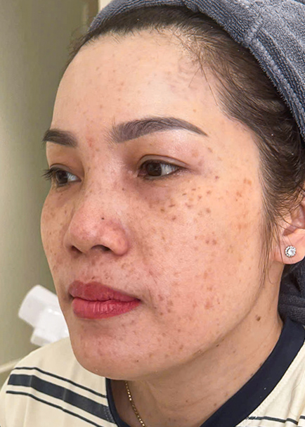 Bớt Hori Chị Mai Phương | Kinh doanh - Trước