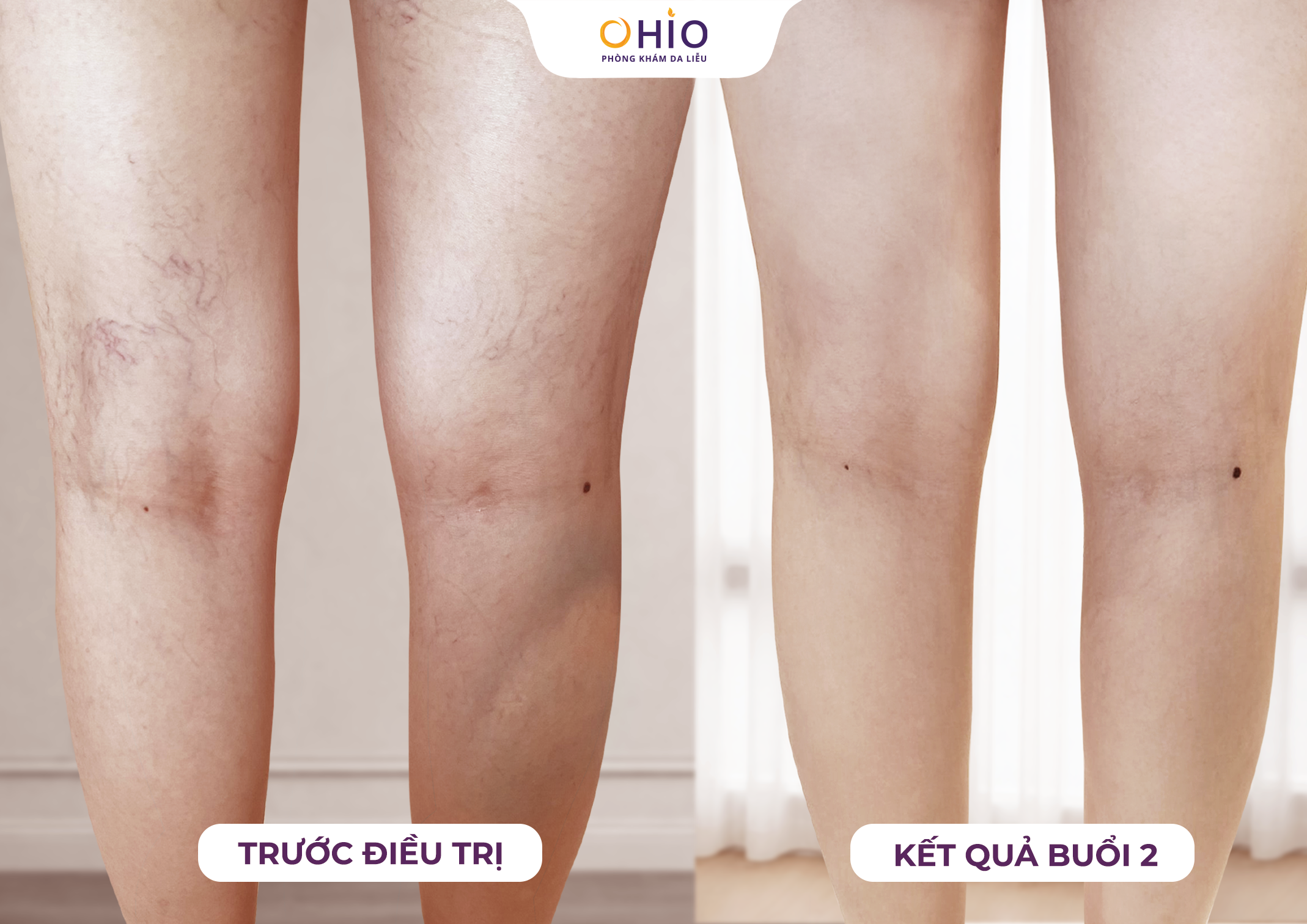 5 Năm Giãn Mao Mạch – 1 Hành trình tìm lại đôi chân đẹp