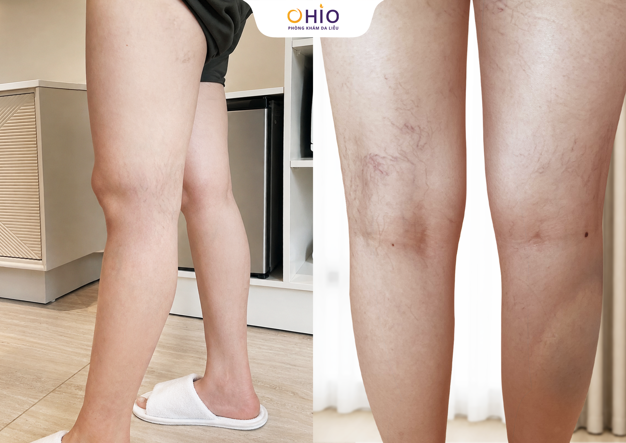 5 Năm Giãn Mao Mạch – 1 Hành trình tìm lại đôi chân đẹp