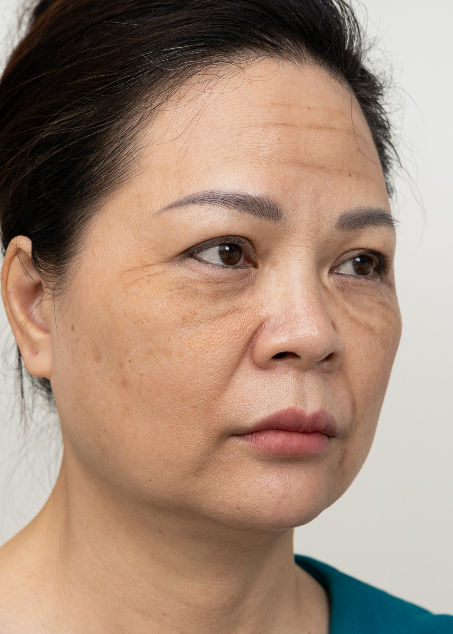 Xoá nhăn Chị Quỳnh Như | Kinh doanh - Trước