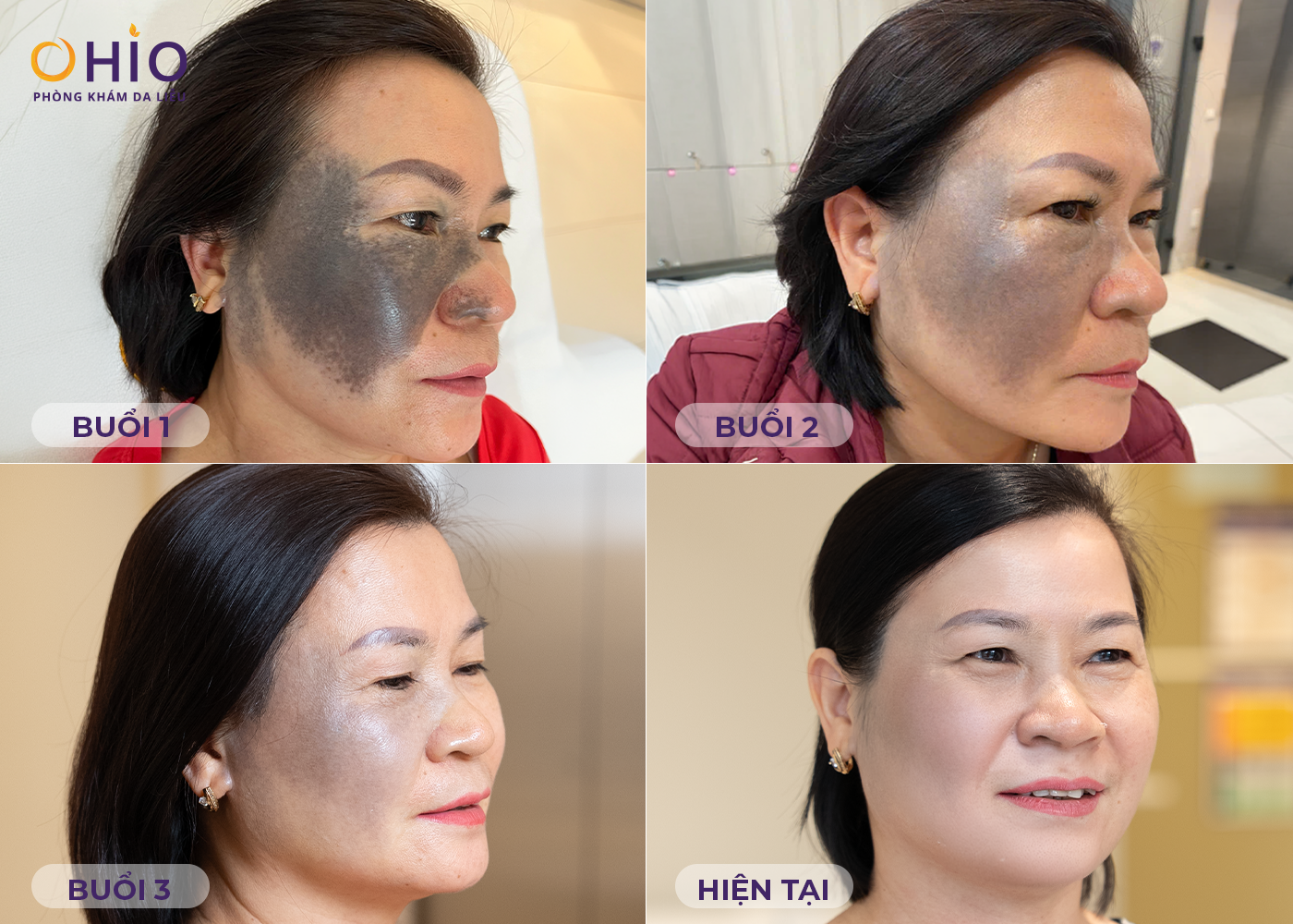 Xóa chàm bớt, U50 tạm biệt khẩu trang tự tin để mặt mộc