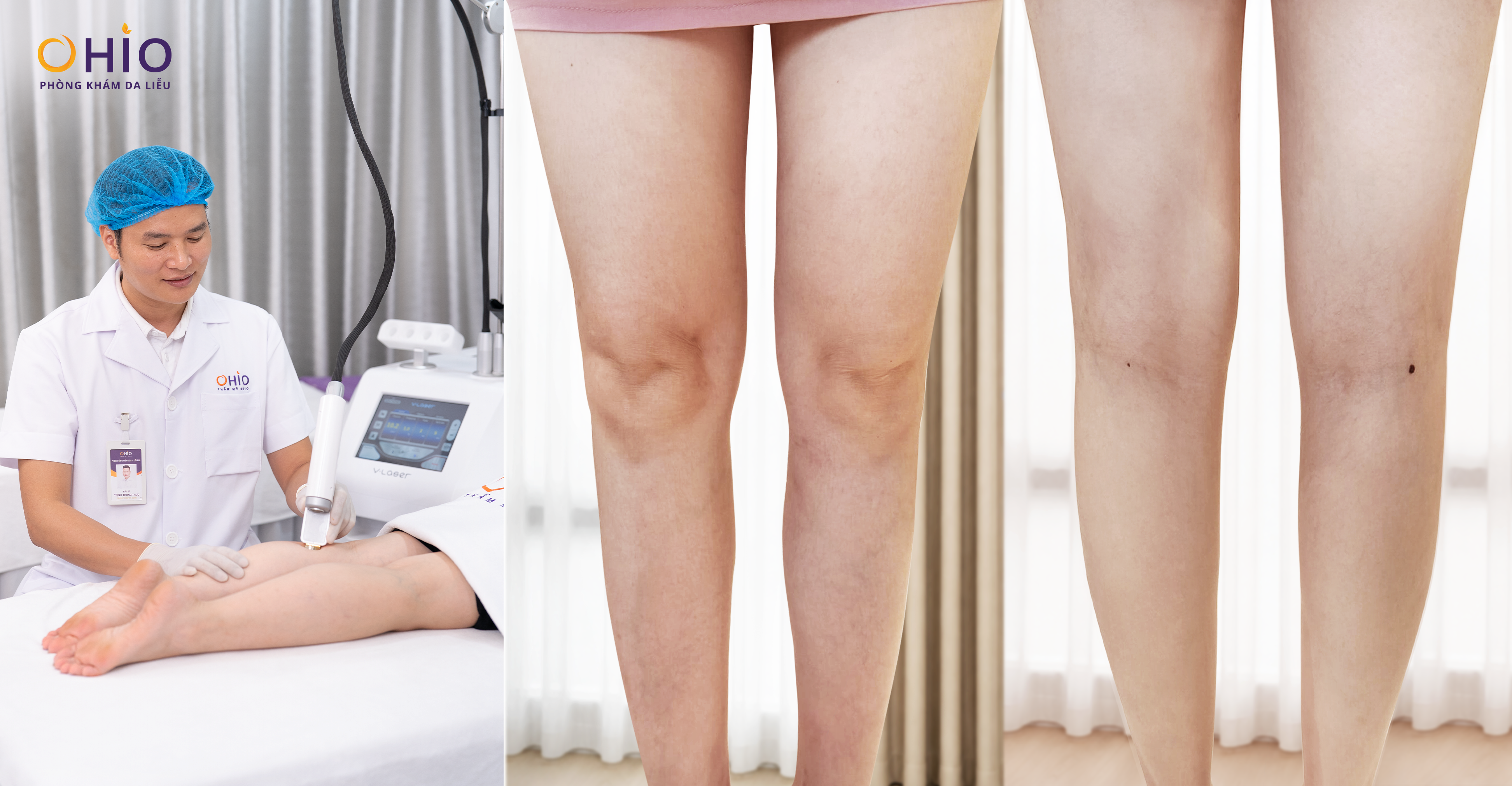 5 Năm Giãn Mao Mạch – 1 Hành trình tìm lại đôi chân đẹp