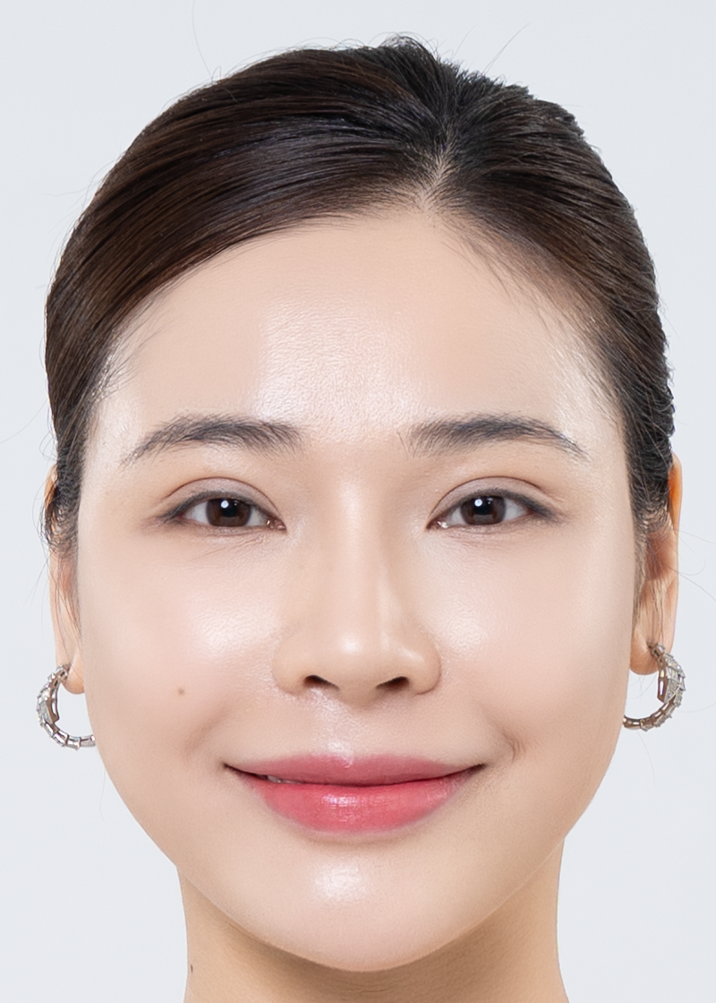 Nâng cơ Chị Thu Trang | Chủ spa - Sau