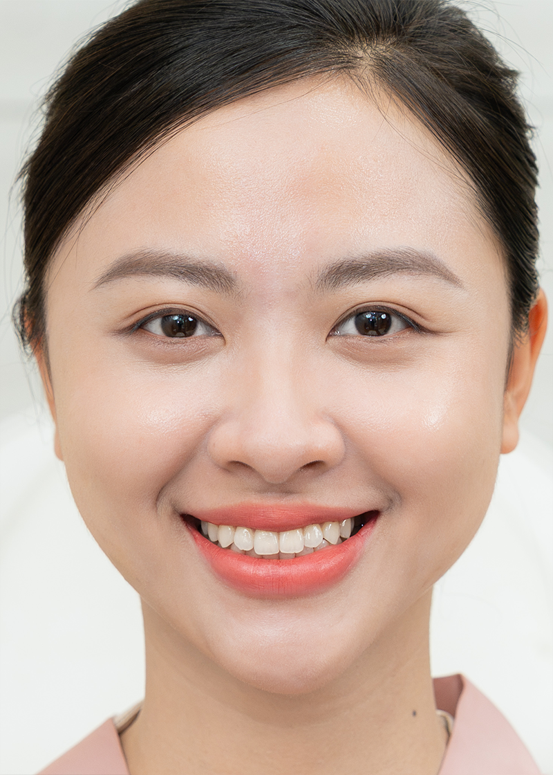 Làm đầy hõm hóp Chị Thảo Nguyên | Quản lí - Sau