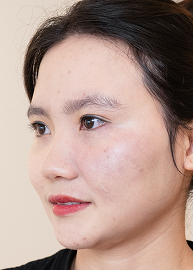 Bớt đỏ Chị Hà Trang | Chủ Spa - Sau