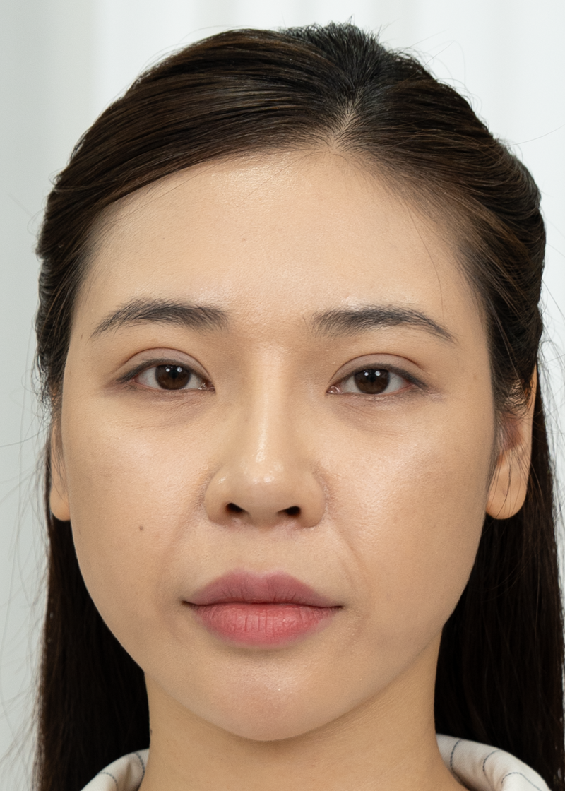 Nâng cơ Chị Thu Trang | Chủ spa - Trước