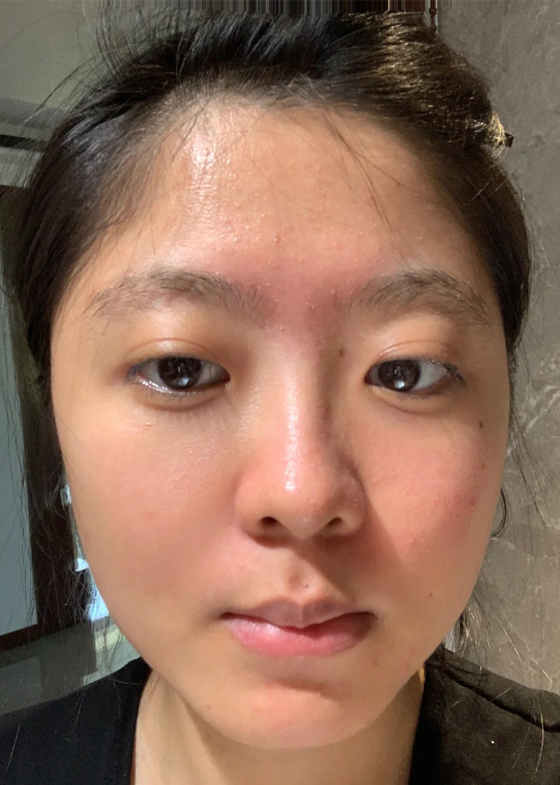 Da hỗn hợp Chị Nhã Ly - Trước
