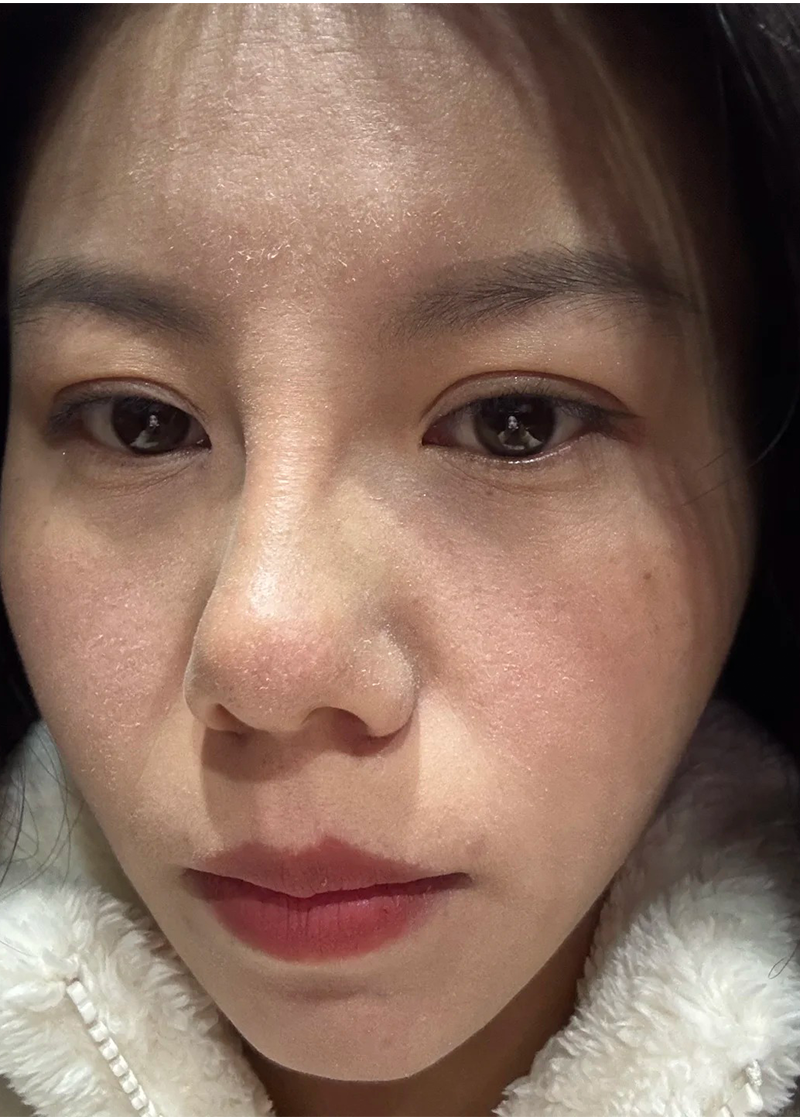 Da khô Chị Diệu Nhi - Trước