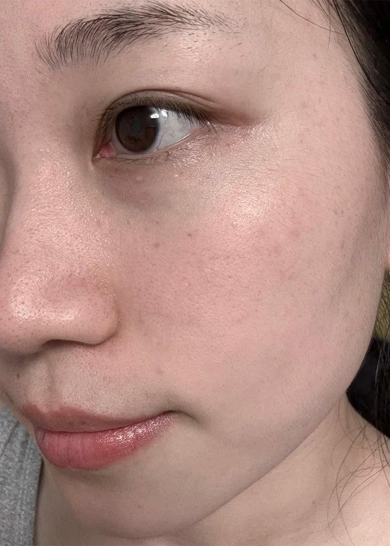 Da thường Chị Thu Uyên - Trước