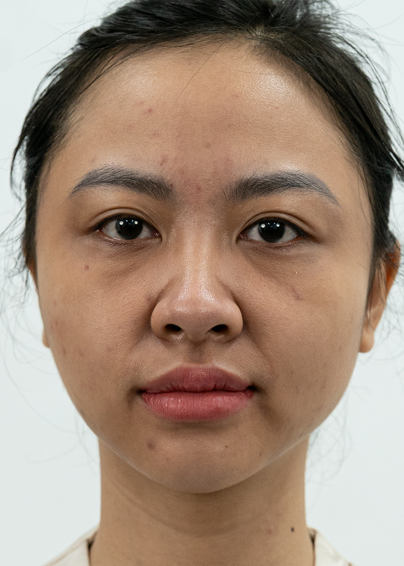 Làm đầy hõm hóp Chị Thảo Nguyên | Quản lí - Trước