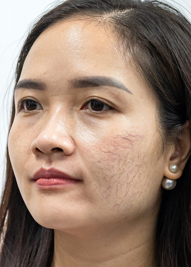 Giãn mao mạch mặt Chị Mỹ Trang | Kinh doanh - Trước
