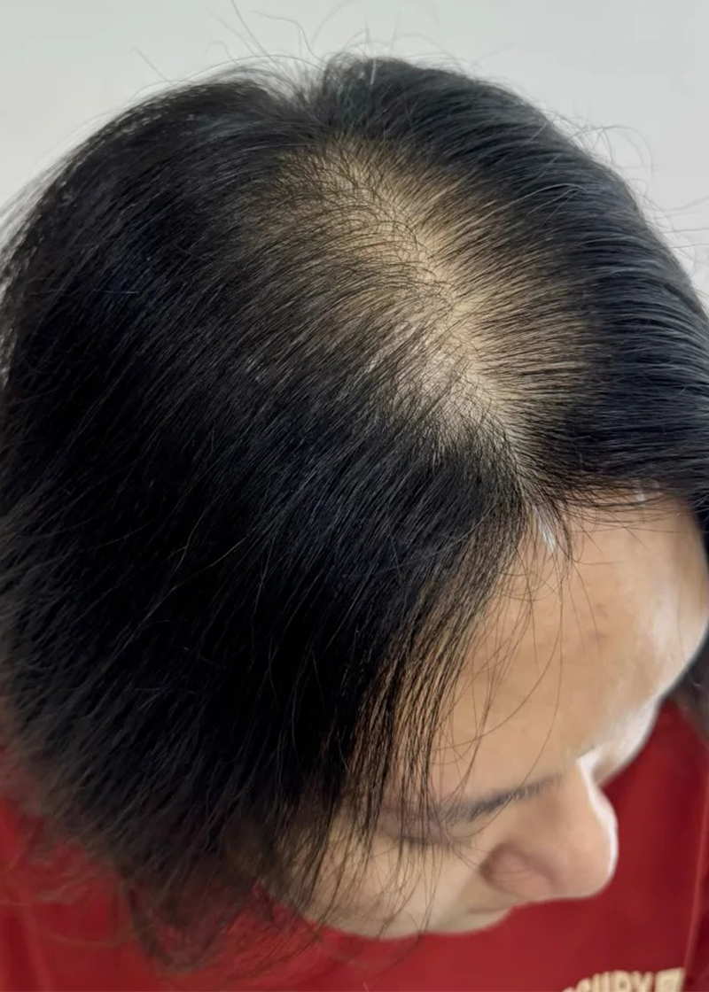 Bệnh hói Chị Lan | Chủ tiệm hoa - Trước