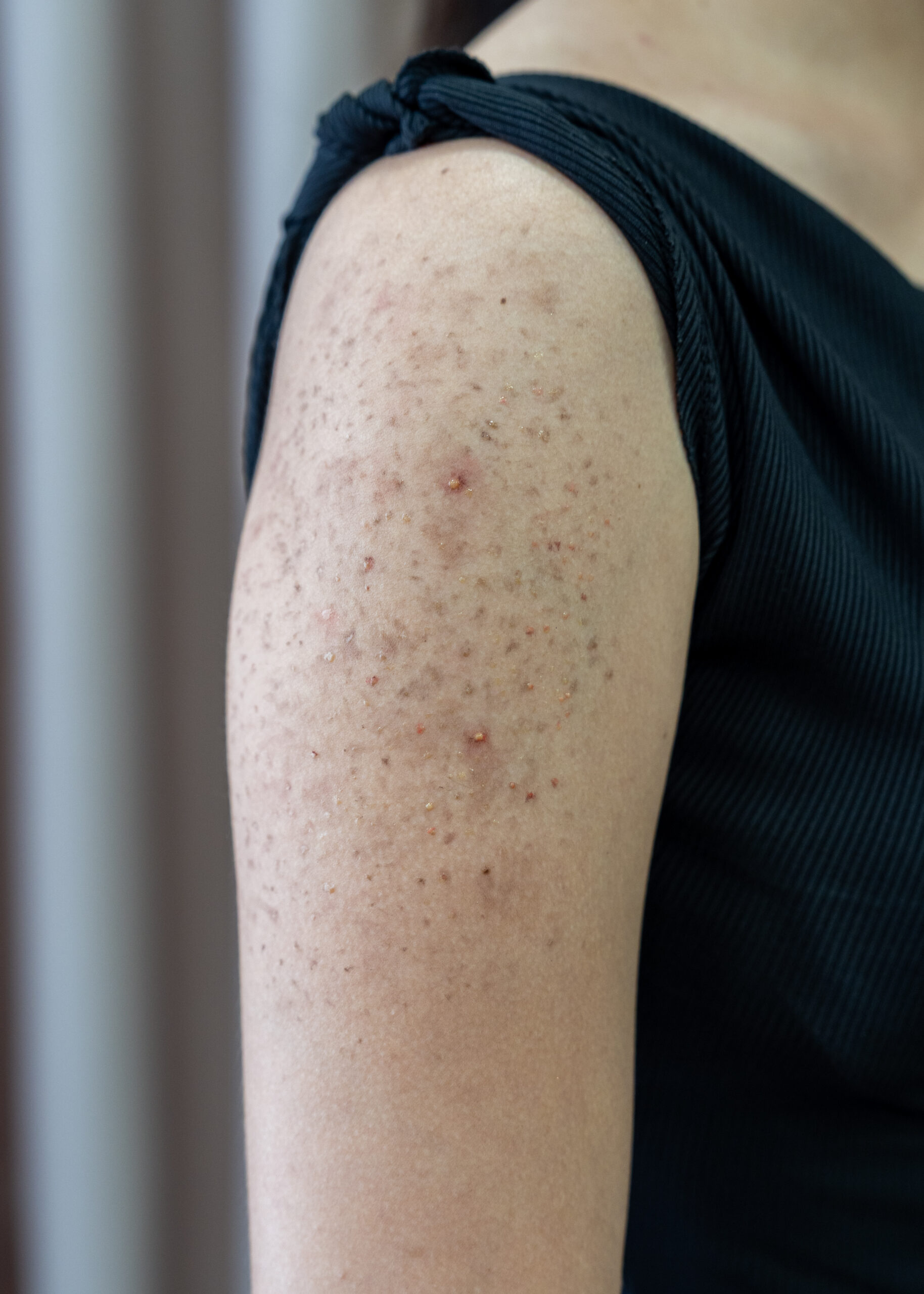 Dày sừng nang lông Chị Thảo Vy | Giám đốc nhân sự - Trước