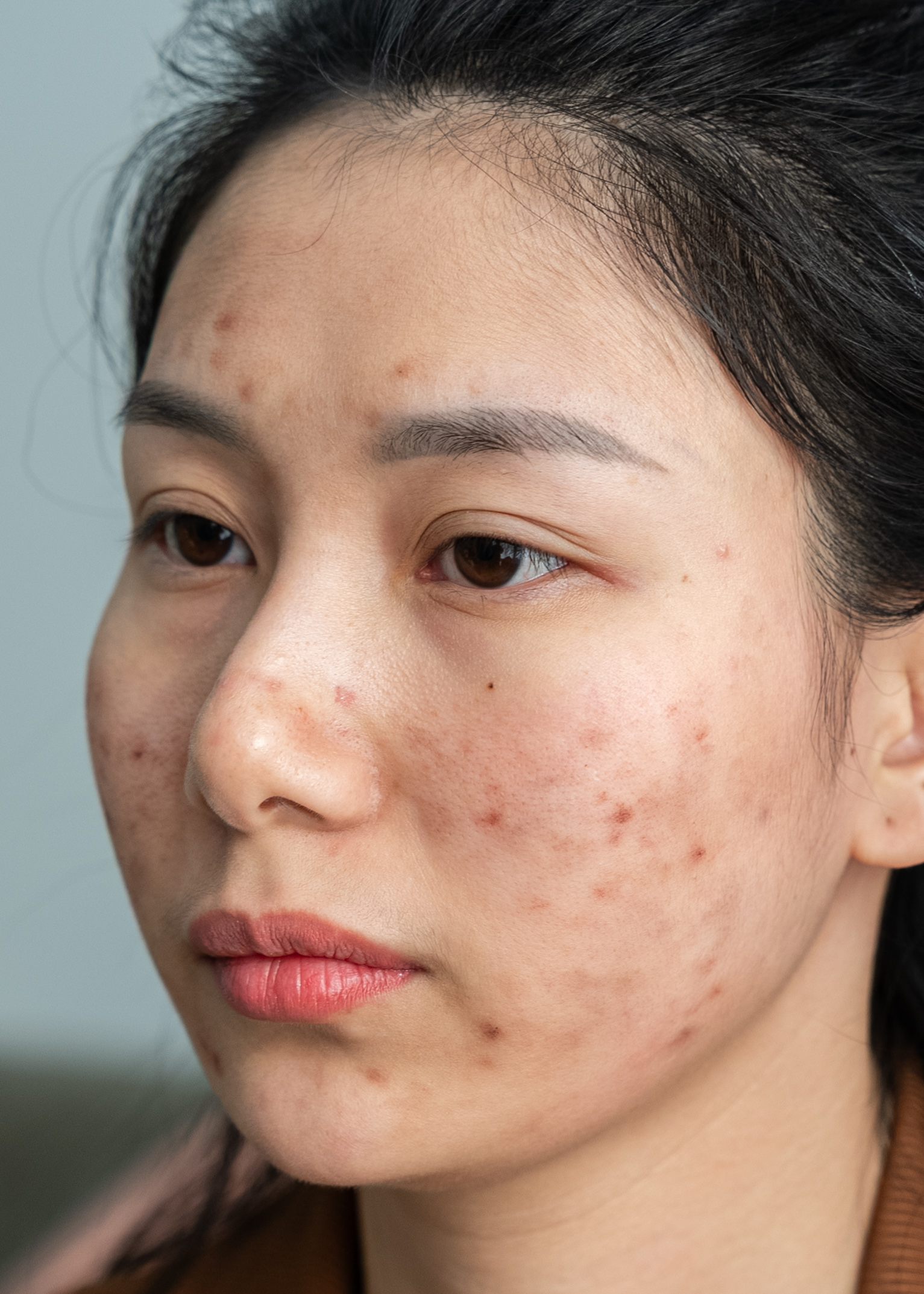 Sẹo rỗ Chị Ngọc Anh | Kinh doanh - Trước