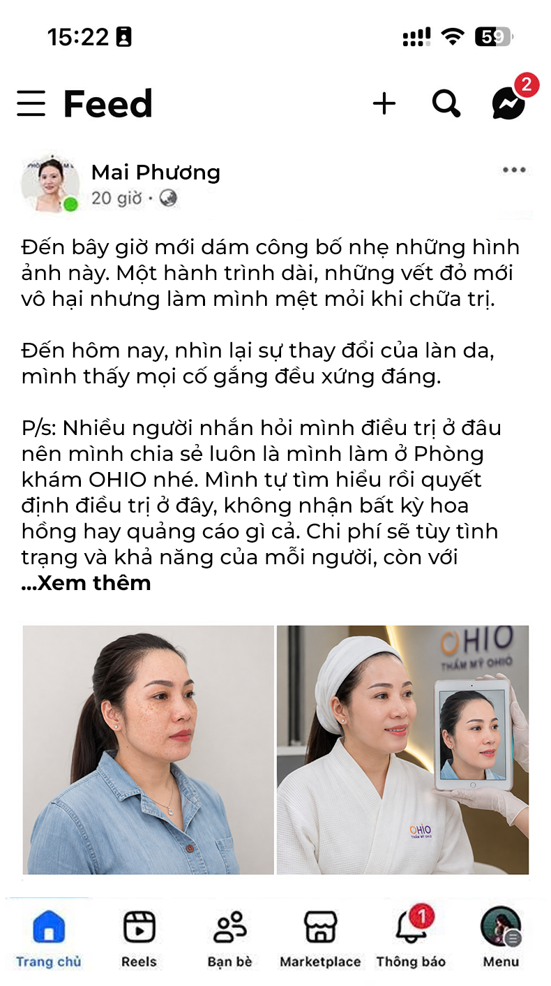 Bớt Hori Chị Mai Phương | Kinh doanh