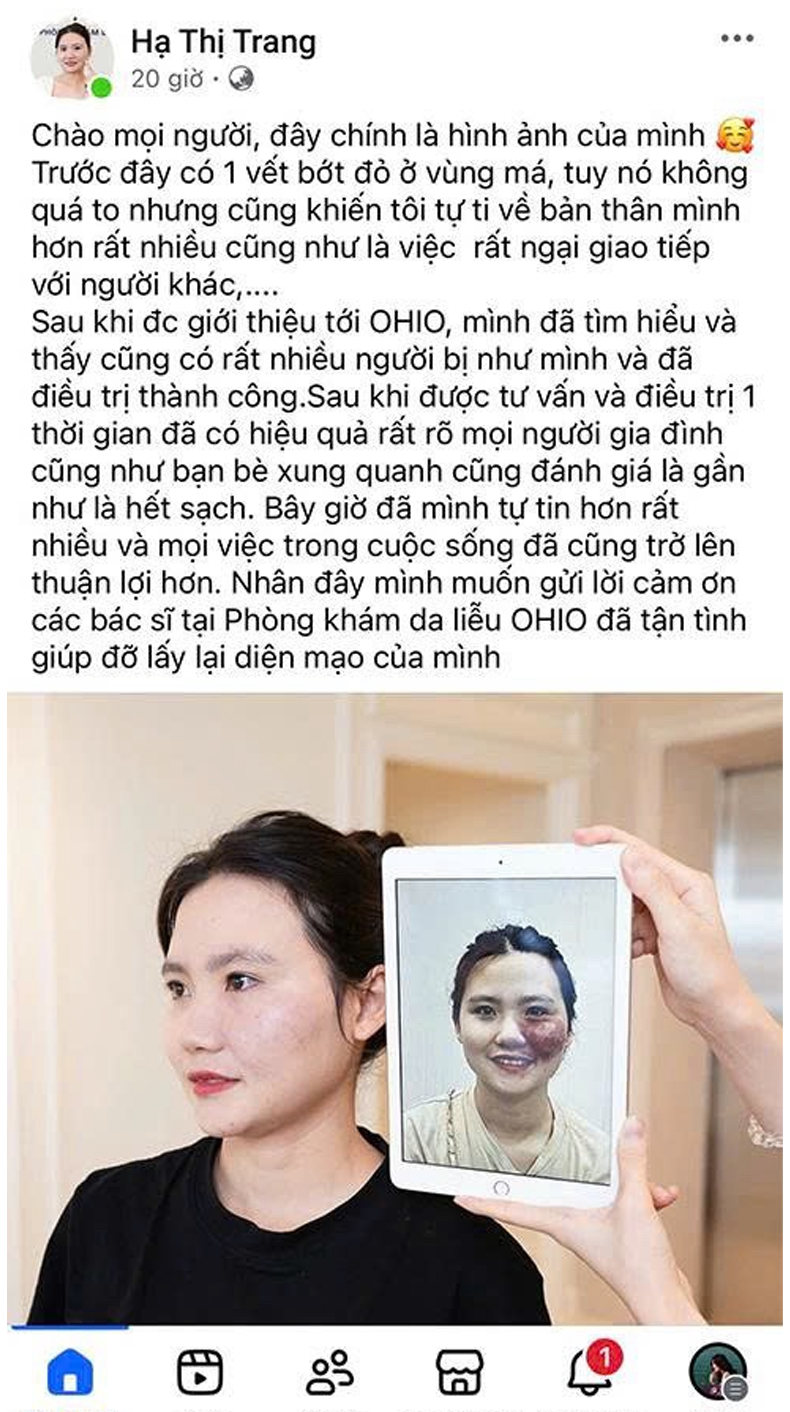 Bớt đỏ Chị Hà Trang | Chủ Spa